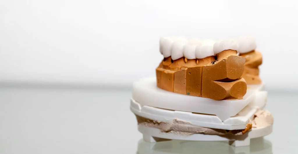 Dental typodont displaying dental crowns used for tooth restoration in Chicago.