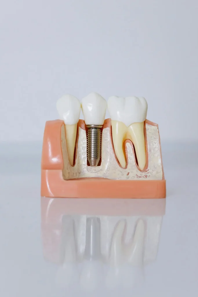 Dental implant in Chicago ready for placement during restorative dental procedure.